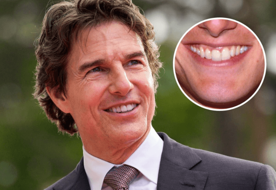 Tom cruise's teeth