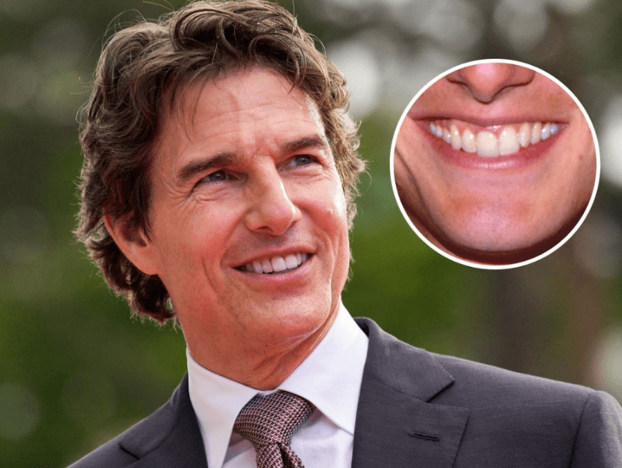 Tom cruise's teeth